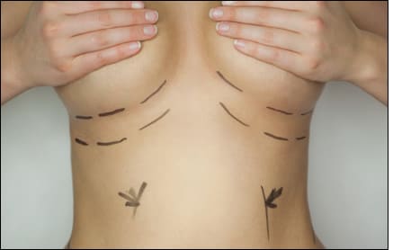 Schnittführung wird bei Patientin an Brustumschlagsfalte angezeichnet