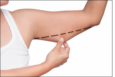 Patientin zeigt erschlafftes Hautgewebe am linken Arm