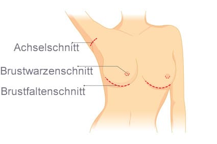 Skizzierung verschiedener Möglichkeiten der Implantatplatzierung bei Brustvergrößerungen